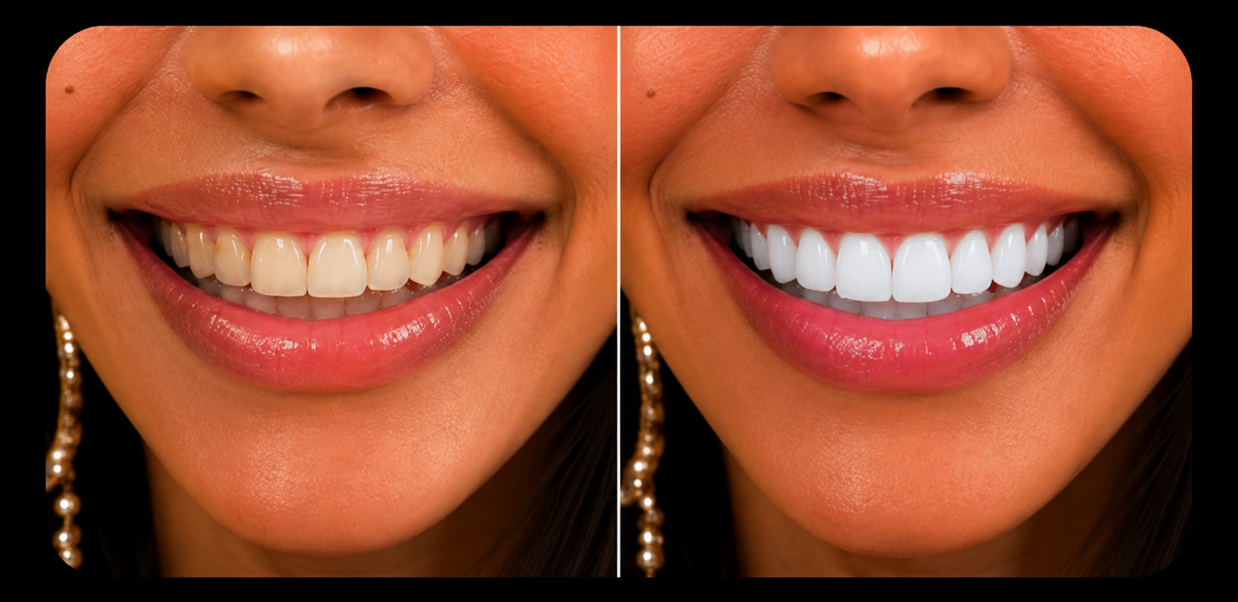 Vorher / Nachher – Bleaching & Zahnschmuck im Glow Smile Studio Hamburg (1)